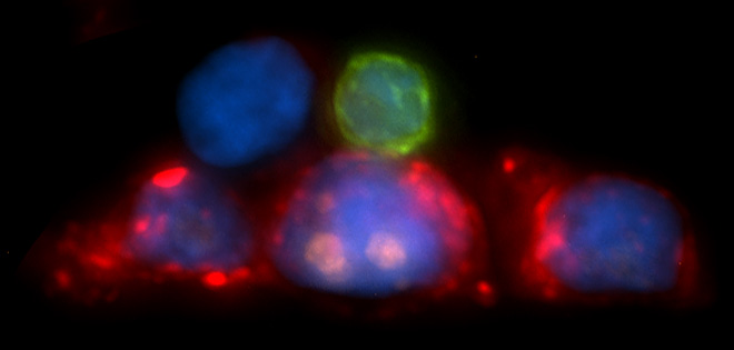 Figure 1: Multicolor imaging of CTC cluster captured on CTC chip...